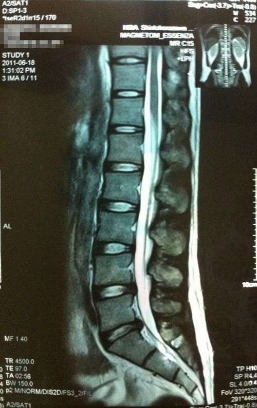 椎間板ヘルニア　MRI